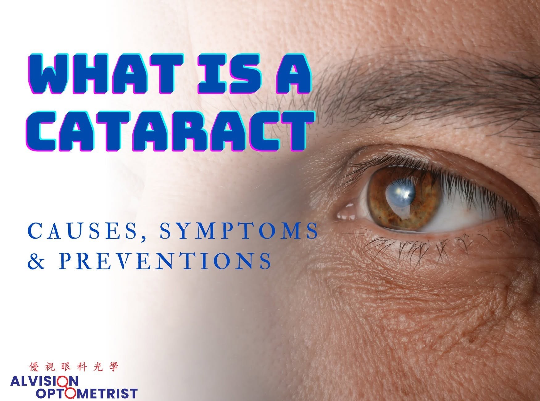 Cataract Tips